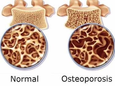 Osteoporosis: ¿Quiénes están en riesgo?