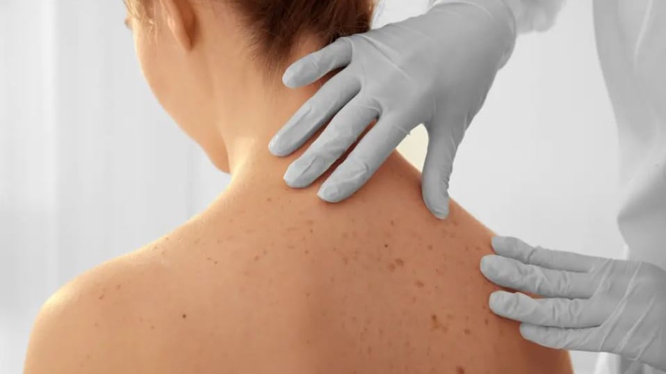 Los médicos recomiendan hacerse un examen una vez al año para detectar cáncer de piel. | Foto: Stock.adobe.com