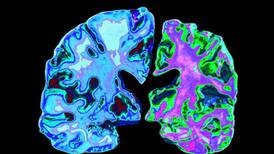 Nuevo estudio puede ayudar a pacientes a detectar proteínas tóxicas antes de que aparezcan síntomas del Alzheimer